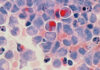 gefärbte Krebszellen
